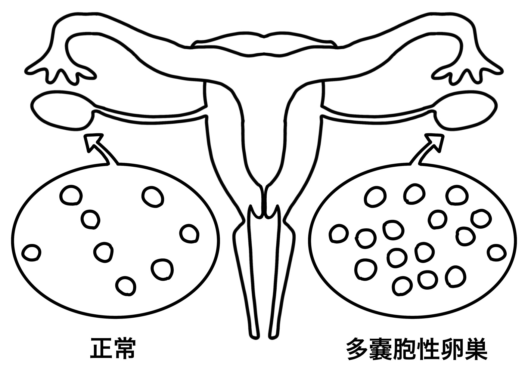 多嚢胞性卵巣症候群(PCOS)